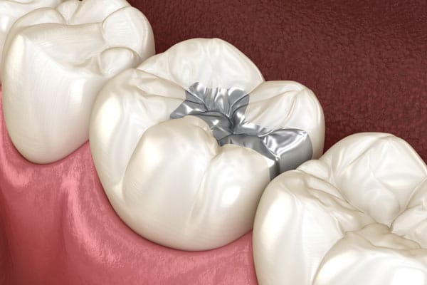 DENTAL SEALANTS Bellevue