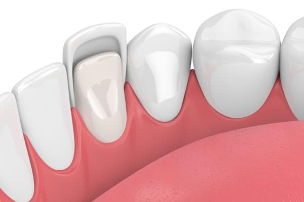 Dentist Bellevue WA - Why Your Teeth Need Trimming Prior to Getting Veneers  - Cooley Smiles