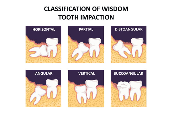 Wisdom Tooth