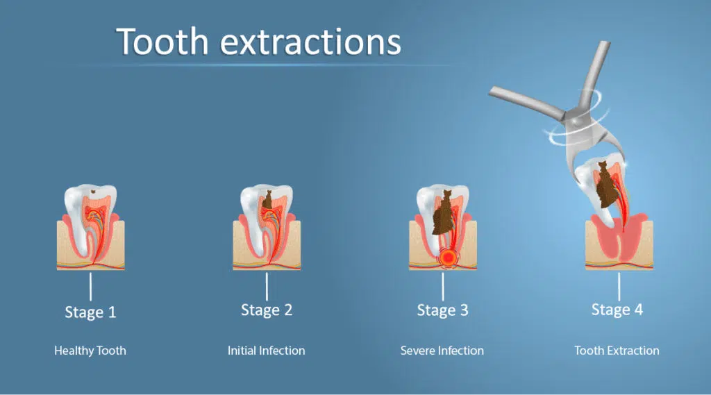 TООTH EXTRACTIONS