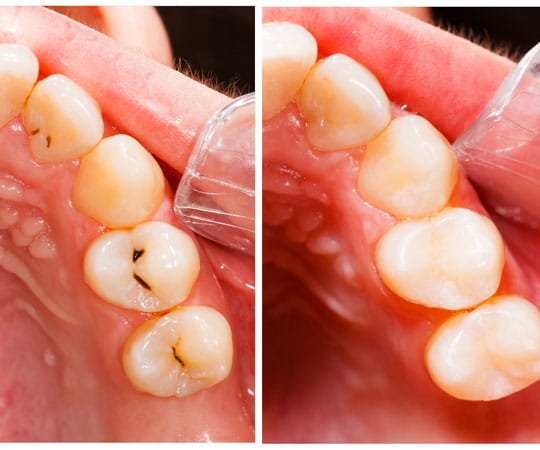 Before and After dental filling at Bellevue Azalea Dentistry