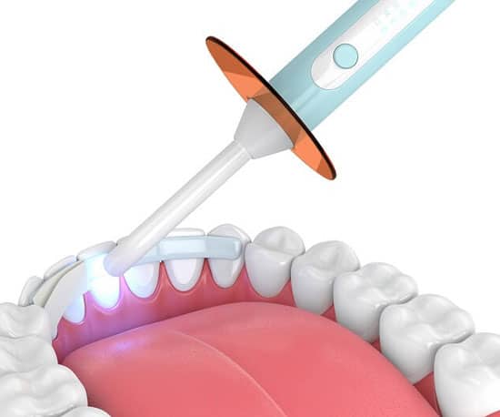 This is how dental bonding procedure is carried out at Azalea Dentistry in Bellevue,WA