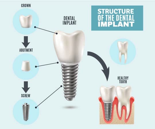 Get your dental implant from a qualified dentist in Bellevue, WA. Call Bellevue Azalea Dentistry,