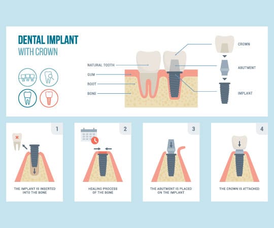 Get a Dental Implant for a missing tooth at Bellevue Azalea Dentistry.