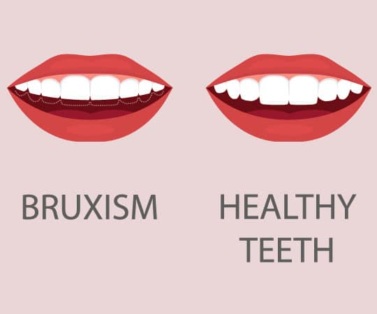 Get teeth grinding guard at Bellevue Azalea Dentistry to prevent bruxism symptoms