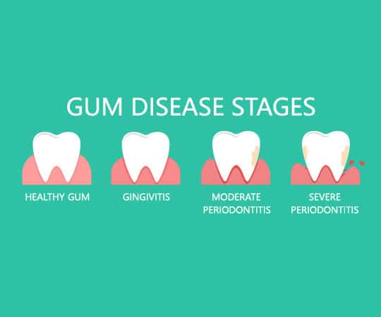 Contact Bellevue Azalea Dentistry if suffering from Gum Disease.