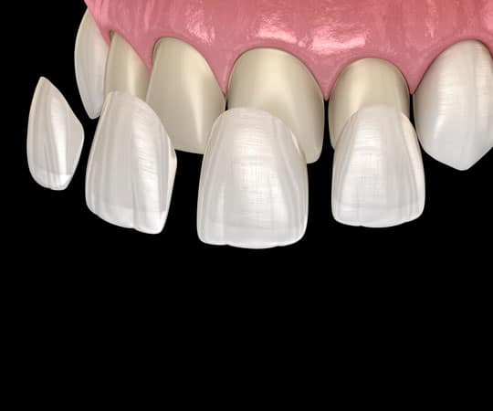 Dental Veneers Bellevue, WA - Artisan Dental - Porcelain Veneers Near Me -  Laminates