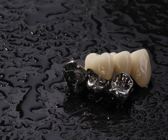 Book your appointment today with Bellevue Azalea Dentistry to know more about metal and Porcelain Dental Crowns.