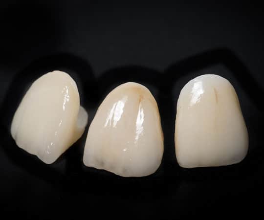 Opt for dental crown instead of filling to keep a cavity tooth for the best shape and health.