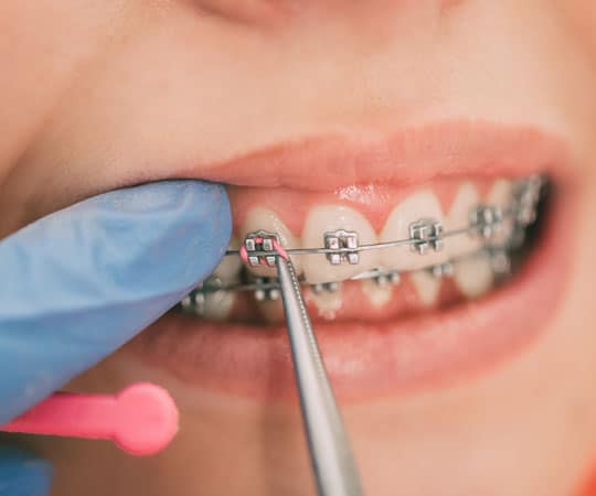 No evidence proves that wearing braces will cause your gums to recede.