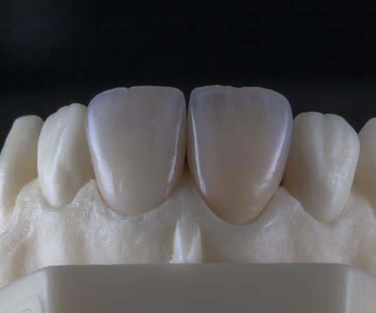 Contact Bellevue Azalea dentistry for dental restorations using dental veneers