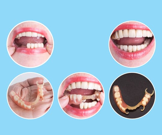 A dental bridge can replace more than one tooth while only requiring one fixture. Book your appointment today with Bellevue Azalea Dentistry.