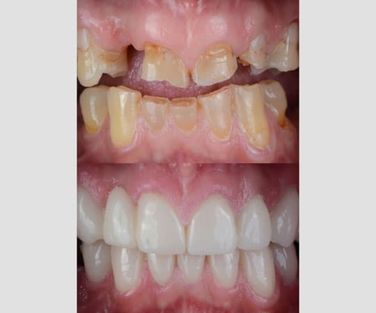 Start your smile makeover with Bellevue Azalea Dentistry with many available options.