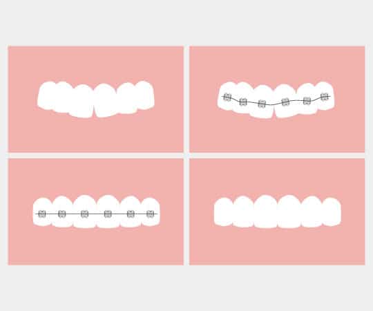 Teeth straightening Solution without braces