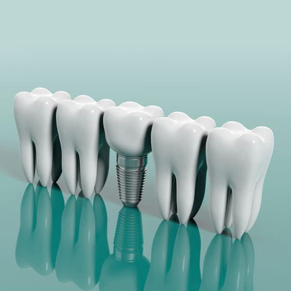 Visit Bellevue dentistry if you have gum disease and wanted to go for dental implants. Call now to book an appointment.