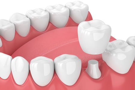 Dental crown treatment at Azalea Dentistry in Bellevue