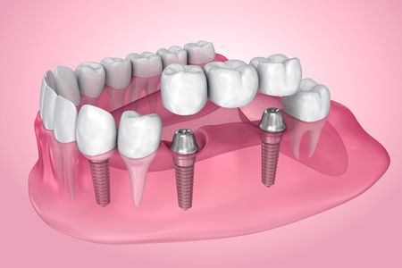 Dental implants at Azalea Dentistry in Bellevue