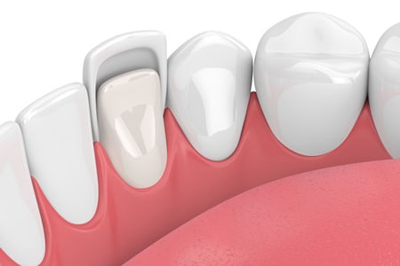 Porcelain dental veneers in Bellevue