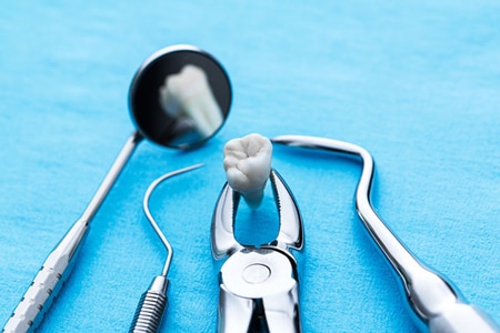 Tooth extraction treatment at Azalea Dentistry in Bellevue