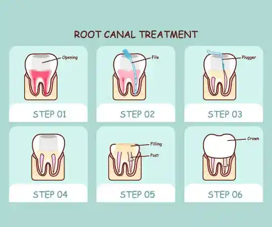 Bellevue Azalea Dentistry provide root canal treatment. Call now!