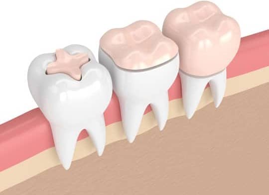 Types of Dental fillings offered by Bellevue Azalea Dentistry