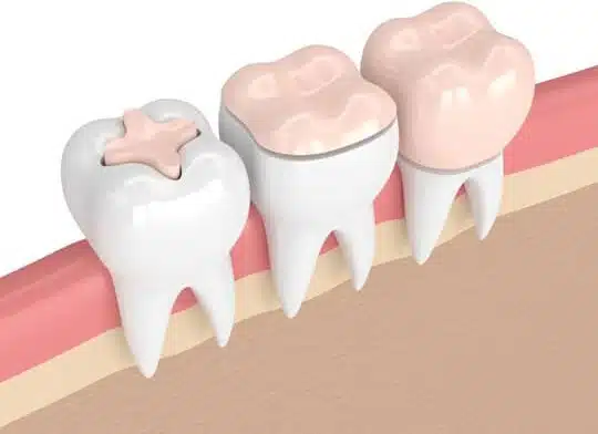 Types of Dental fillings offered by Bellevue Azalea Dentistry